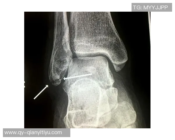 弗兰克谈小卡伤情揭示脚踝问题背后的复杂性与脚部损伤情况 弗兰克谈小卡伤情揭示脚踝问题背后的复杂性与脚部损伤情况